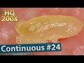 #24 Continuous Removal of Blackheads Close up 200X - Squeezing Blackheads