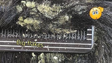 Satisfying Dandruff Removal Big Flakes - Dry Scalp  Treatment #565