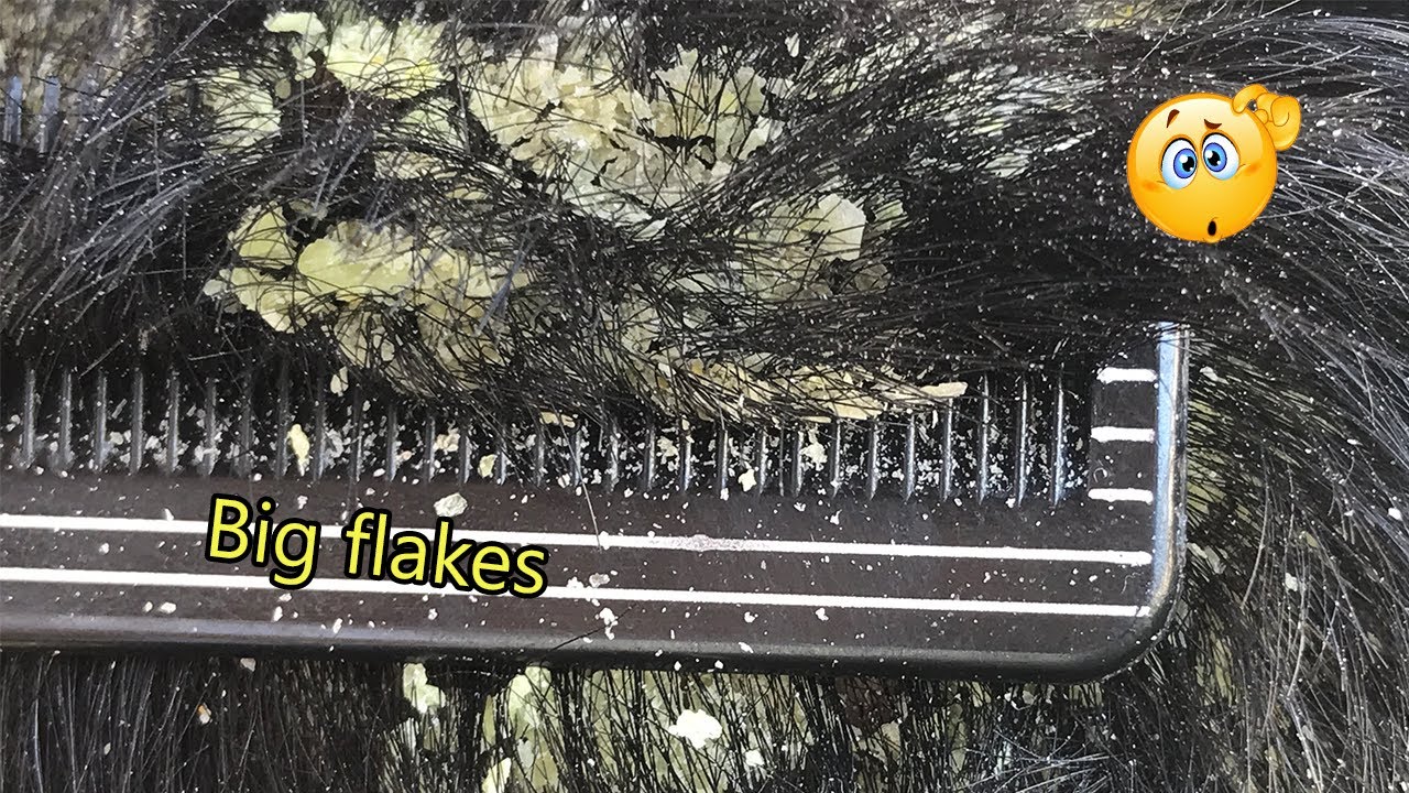 Satisfying Dandruff Removal Big Flakes - Dry Scalp  Treatment 