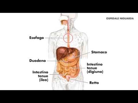 Video: Varici Esofagee Sanguinanti: Panoramica, Cause E Fattori Di Rischio