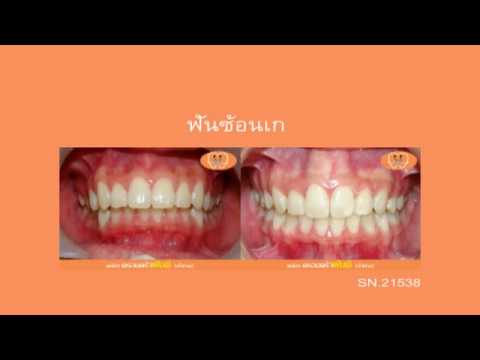 ฟันยื่น (Dental Protrusion) C.21538