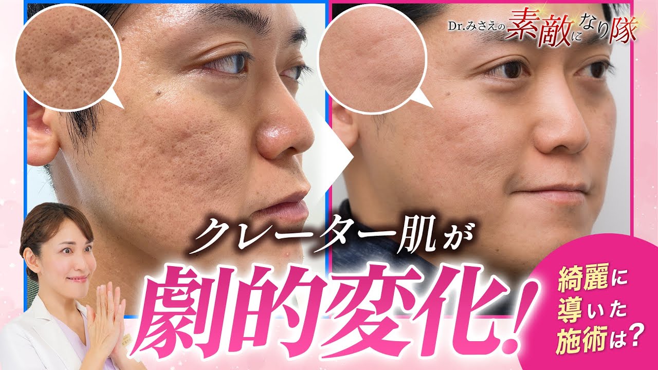 クレーター 治し 方
