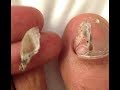 Toenail Torn Off? Try This!