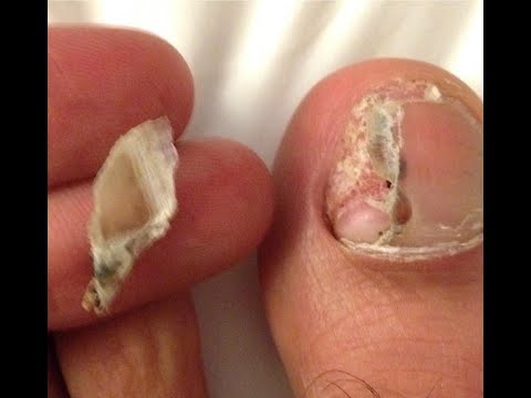 Toenail Torn Off? Try This! - YouTube