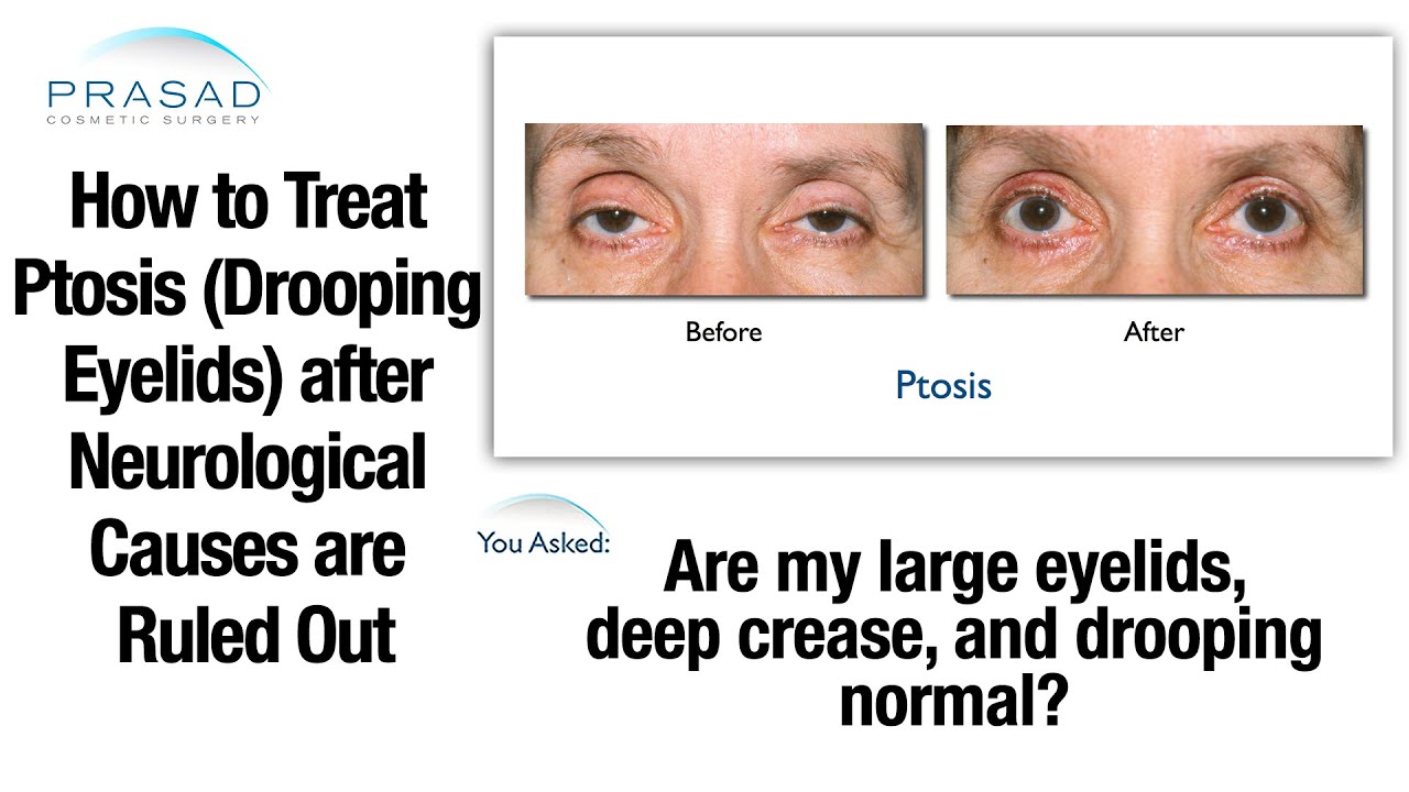 What Causes Droopy Eyelids