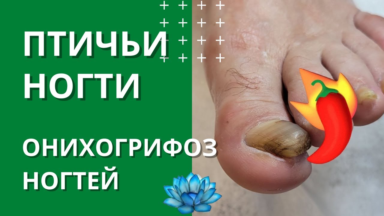 Заболевание ногтей на ногах. Онихогрифоз ногтей. - YouTube