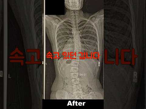 더 이상 속지 마세요 척추측만증은 교정할 수 없습니다