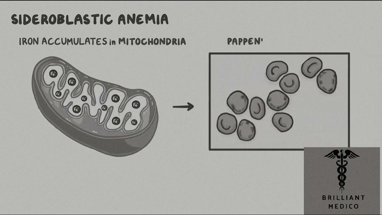 Sideroblastic Anemias diagnosistreatmentanimated lecture sideroblasticanemia