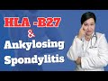 Hlab27 what does it mean what is your risk for ankylosing spondylitis