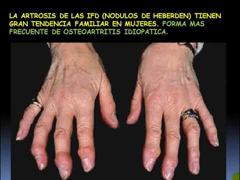 Vídeo: El Ciclo Antiinflamatorio Activina-folistatina Se Desregula En Fibroblastos Sinoviales