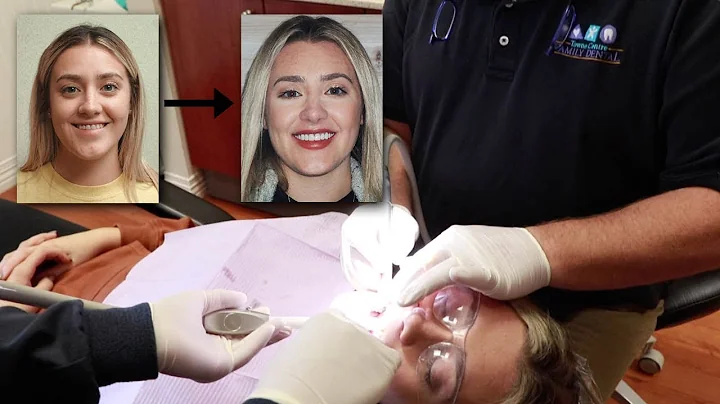 Julia's Veneer Journey  - Enamel Dysplasia Patient