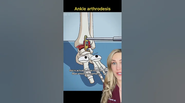 Doctor explains: ankle fusion surgery