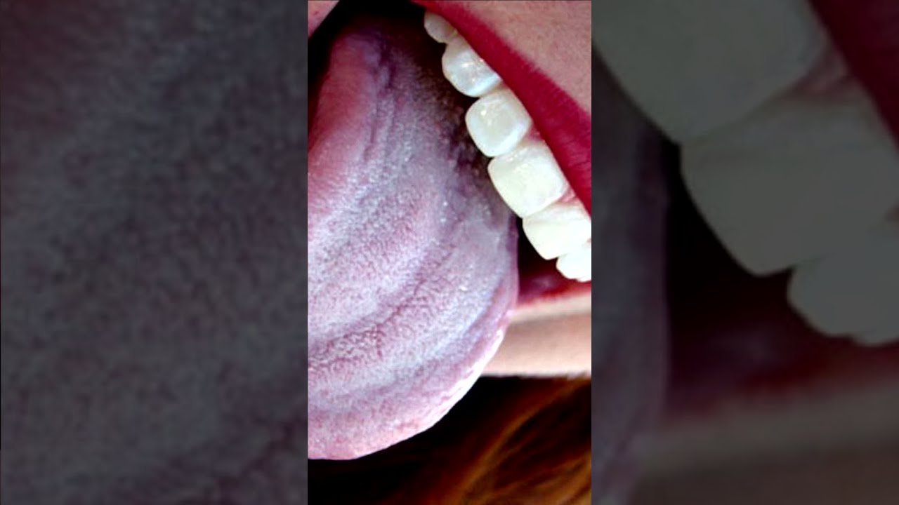 ⛑ Убойное средство от Грибка Кандиды 🍄 