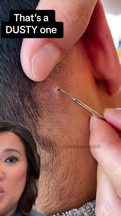 Terminal Hair in Scalp