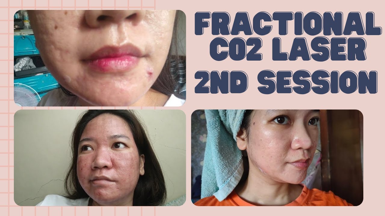 CO2 Laser Resurfacing Tampa