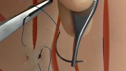 Chirurgische overgangen van forehand naar backhand