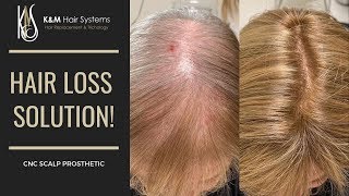 HAIR LOSS SOLUTION - CNC INSTALLATION | K&M HAIR SYSTEMS