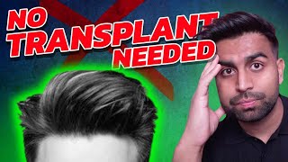 How To Get a Full Head of Hair Without a Hair Transplant!