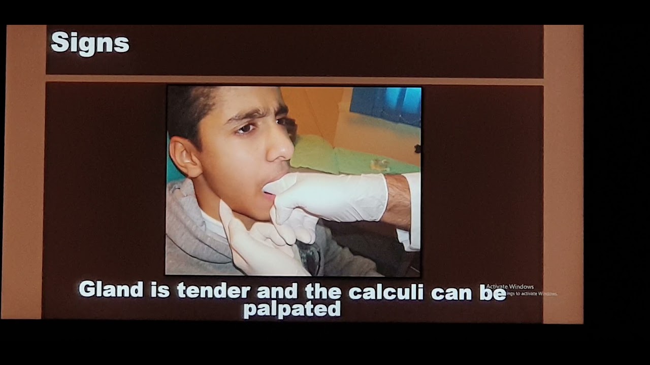 Salivary gland stones Patient teaching programme Urdu YouTube