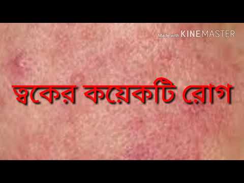 ভিডিও: ছাই রোগ দেখতে কেমন?