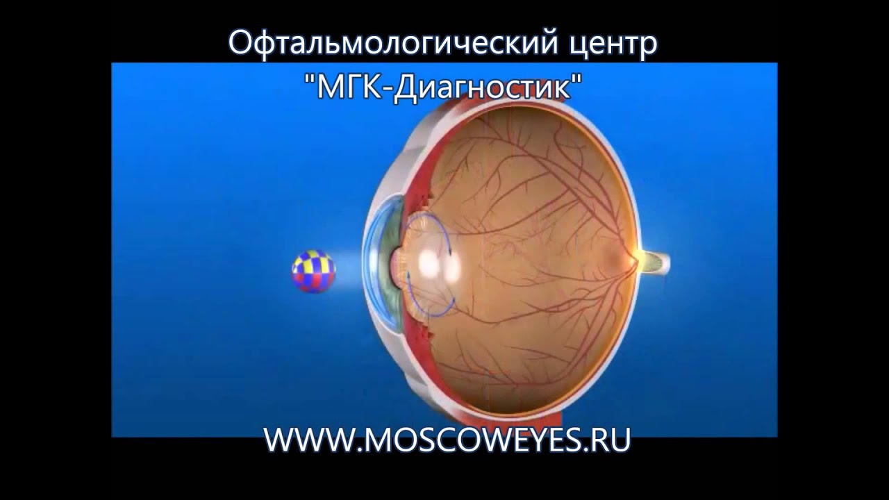 Лазерная Дисцизия Вторичной Катаракты Цена