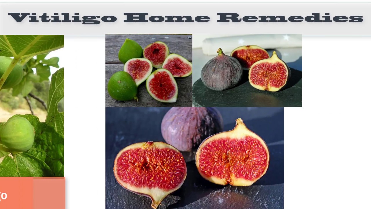 25 Vitiligo Home Remedy Figs, Walnuts, Indian Lilac Leaves, Barberry