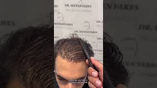 4,100 Grafts Hair Transplant | Norwood 4 | 9-Month Result ( Wet Hair )