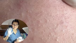 Acne Treatment Huong Da Nang#603 _ 2024  #hiddenacne