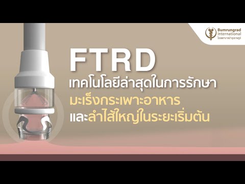 มะเร็งกระเพาะอาหารและมะเร็งลำไส้ในระยะเริ่มต้น สามารถรักษาโดยไม่ต้องผ่าตัด ด้วยเทคโนโลยี FTRD