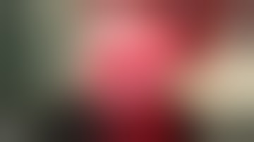 Jejunal Adenocarcinoma With obstruction - Lap segmental jejunal resection