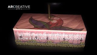 Medical Device 3D Animation Video Marketing