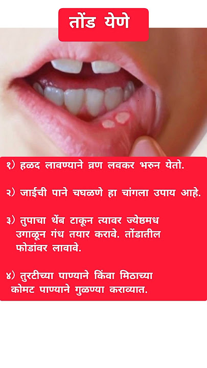 तोंड येणे ।।#shorts #healthtips #selfcare #shortsfeed #ayurveda #shortsvideo #viral