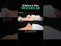 [수술전후] 진짜 코 되찾기 성공 | 디아이성형외과 #코성형 ＃수술전후 ＃코성형후기