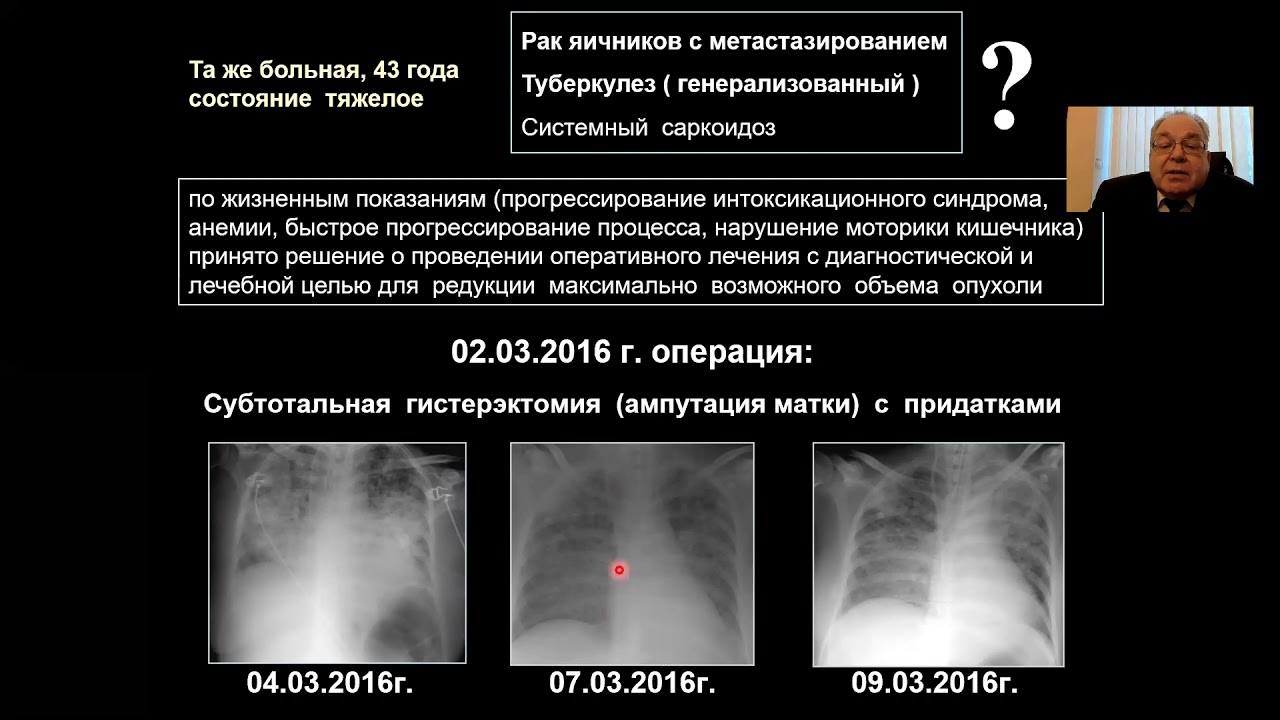 Туберкулез видеоролик