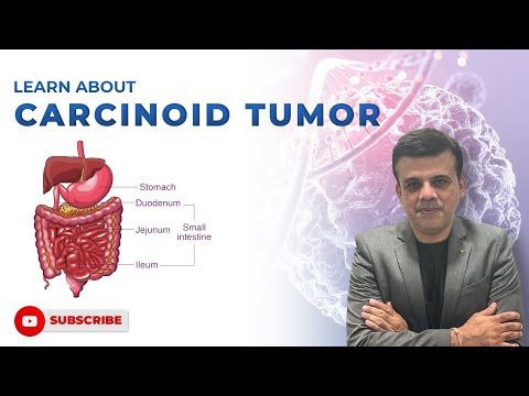 Carcinoid Tumor|How do you get carcinoid tumor?Can carcinoid tumors be cured?usmle,neetpg, plab,fmge