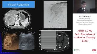 3 Angio CT for Selective Internal Radiation Therapy SIRT - Dr Leong Sum,