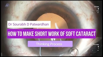 Soft cataract: How to make a short job (hydroprolapse and phacoaspiration) Dr Sourabh Patwardhan