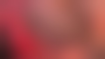 Uniportal Subxiphoid Video Assisted (SVATS) right upper lobectomy