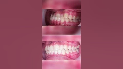 Khắc phục tình trạng răng khấp khểnh bằng phương pháp niềng răng|Nha khoa Hân Đào#shorts #niềngrăng