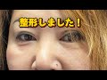 切開二重 #ルーフ切除 #全切開 #眼瞼下垂 #幅広 #手術 #エタクリ #エタプリ #エターナル美容クリニック #全公開 #ダウンタイム #群馬県 #高崎市