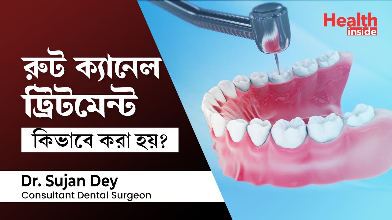 রুট ক্যানেল ট্রিটমেন্ট কিভাবে করা হয়? What is root canal treatment