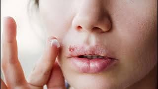 ETHET NE BUZE | HHERPESI NE BUZE | Si sherohen ethet ne buze | #shendeti  #lipstick #buzet #ethet