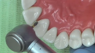 class III composite restoration