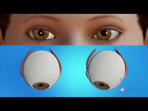 How is strabismus surgery done?