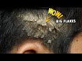 Help Remove Dandruff Big Flakes On The Scalp Using A Small Comb #392