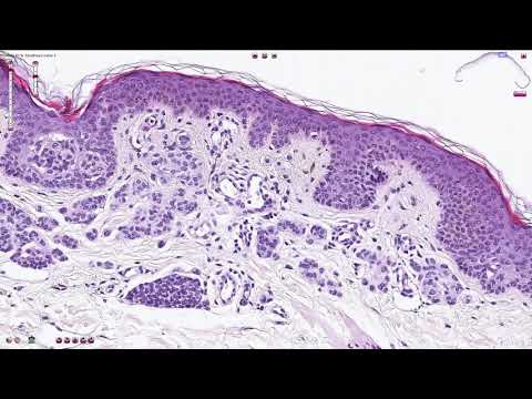 Video: Intraderminis Ir Nepigmentuotas Nevus