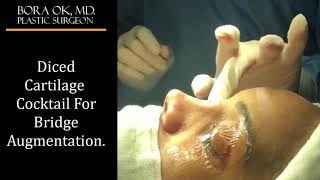 Dr. Bora Ok, MD. - Diced Cartilage Cocktail For Bridge Augmentation (Ethnic Rhinoplasty)