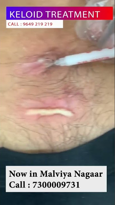 Best Keloid Injection Treatment | Viral #shorts