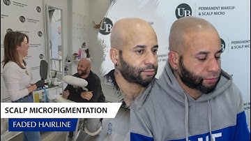 Creating Faded Hairline with Scalp Micropigmentation
