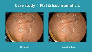 Real-Time Polyp Detection AI For Flat & Isochromatic Cases